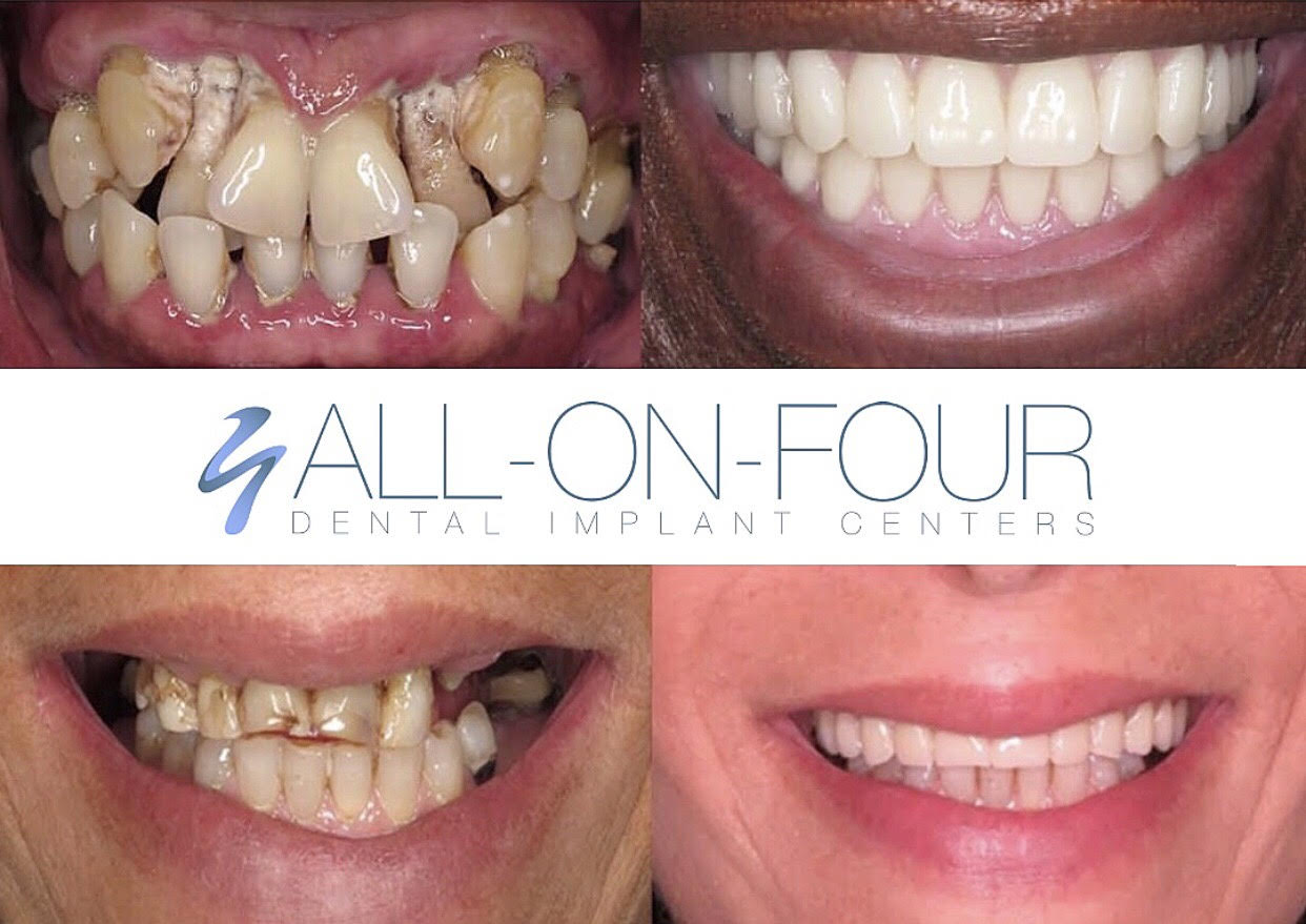 These transformation photos are the patient of Advanced Periodontics & Implant Dentistry. They got a completely restored, beautiful smile in a day. 