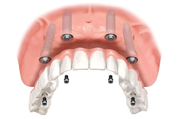 All In One,Dental Implants NYC,All-On-4,All On Four