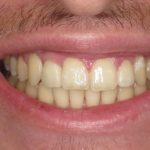 After photo of a patient who has received all-on-4 dental surgery.