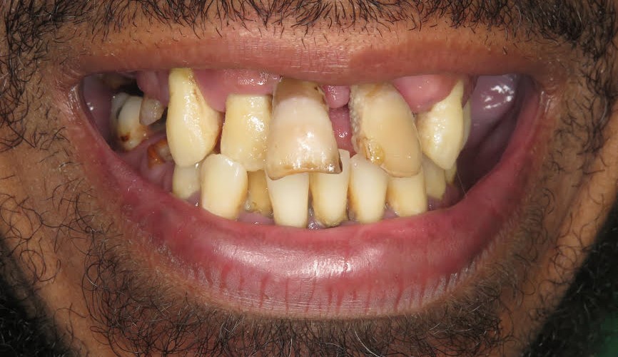 Patient with severe periodontal disease and gingivitis