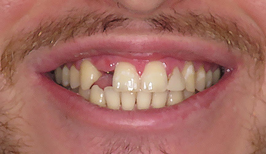 Before image of a patient with missing teeth and periodontal disease
