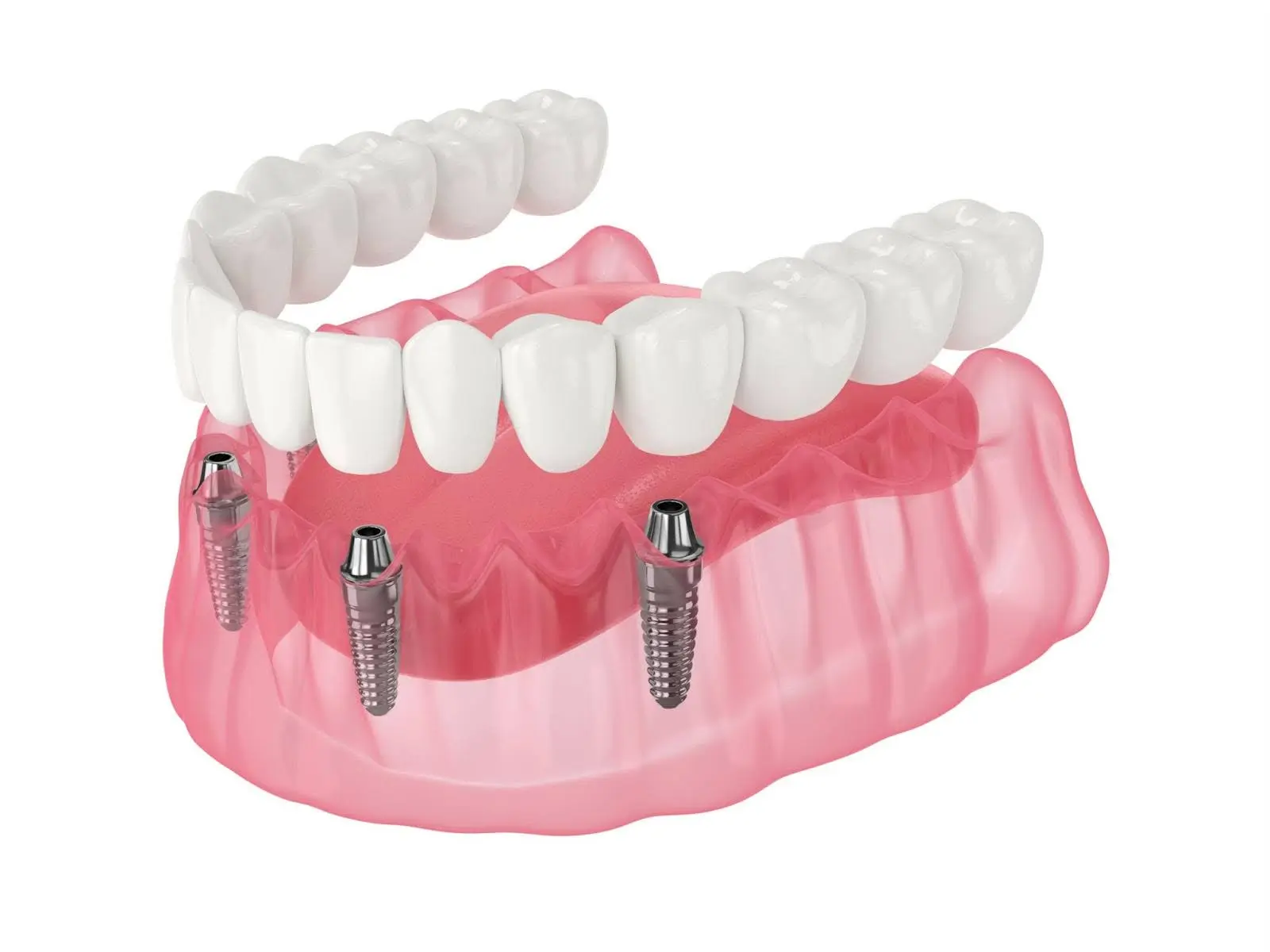 Pros and Cons of Overdentures