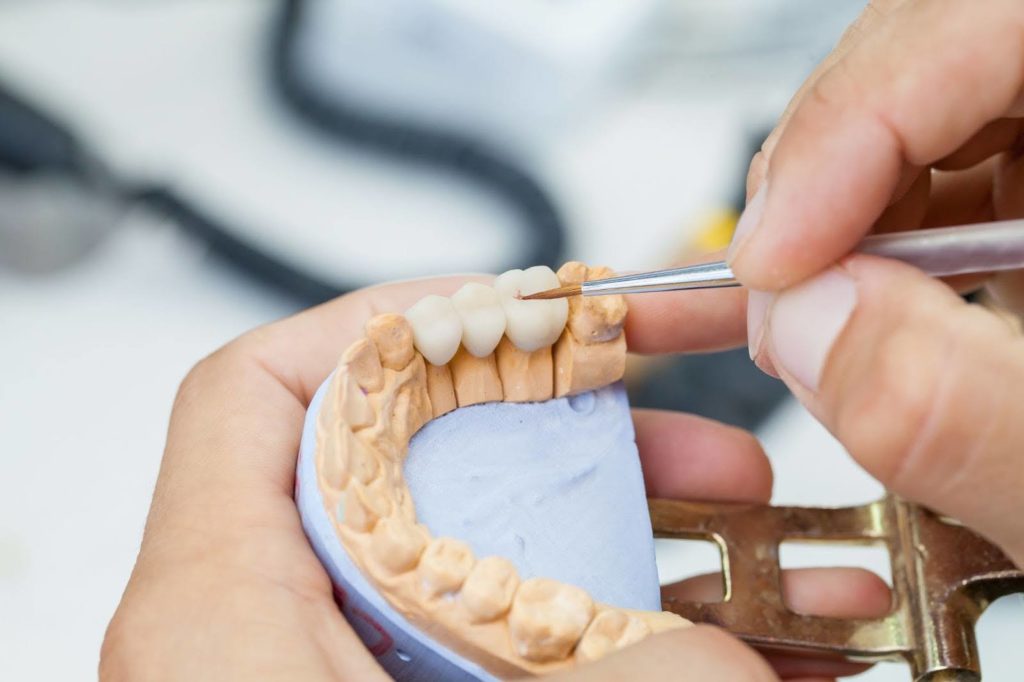 Comprehensive Guide To Full Mouth Dental Crowns Procedure Types And Benefits All On Four