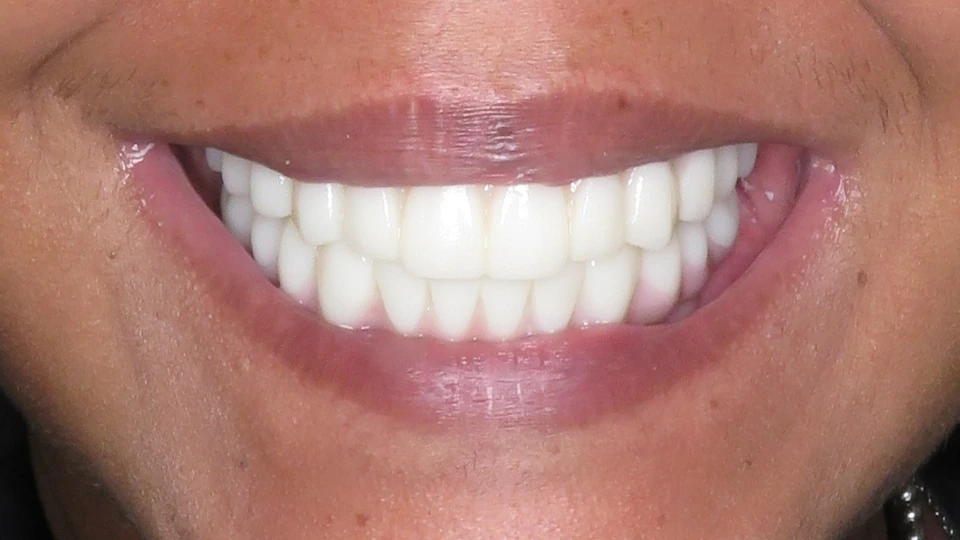 Charlie’s nanoceramic All-on-4 bridge creating a full-mouth appearance