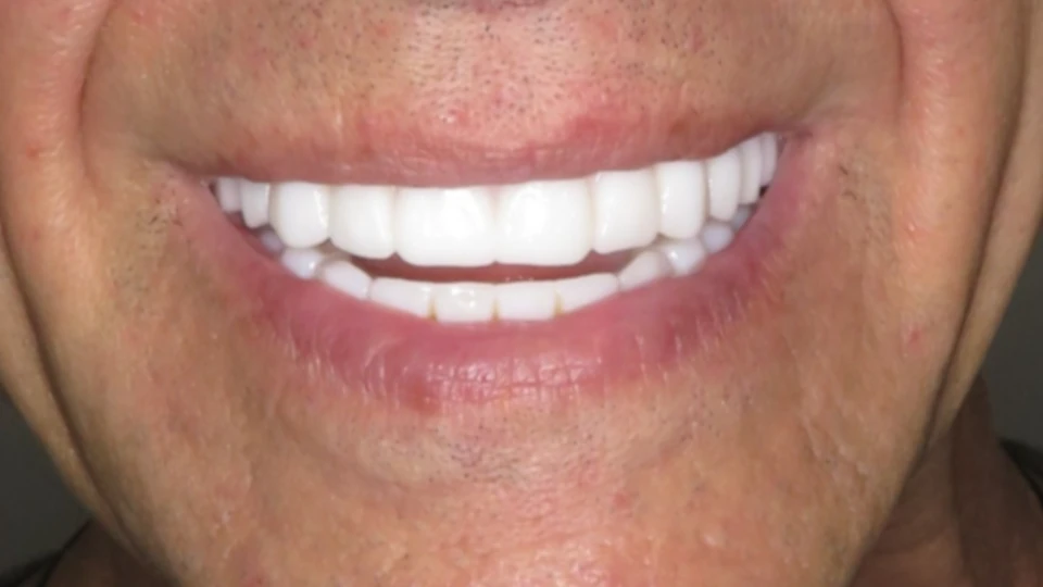 Greg’s custom smile featuring bright teeth and defined canines