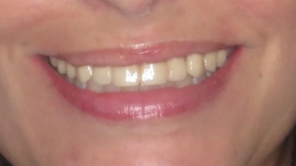 Julia’s upper jaw fully restored with All-on-4 solution