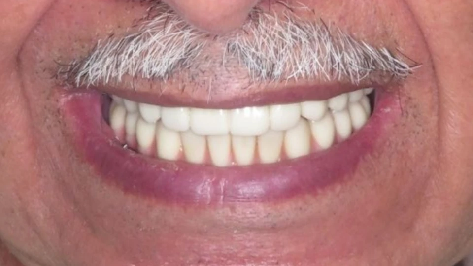 Vincent’s complete smile restoration with implant-supported bridge
