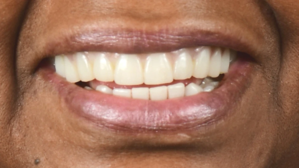 Patricia’s smile fully restored after upper and lower All-on-4