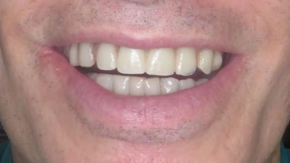Graham’s new upper All-on-4 bridge with lower natural teeth