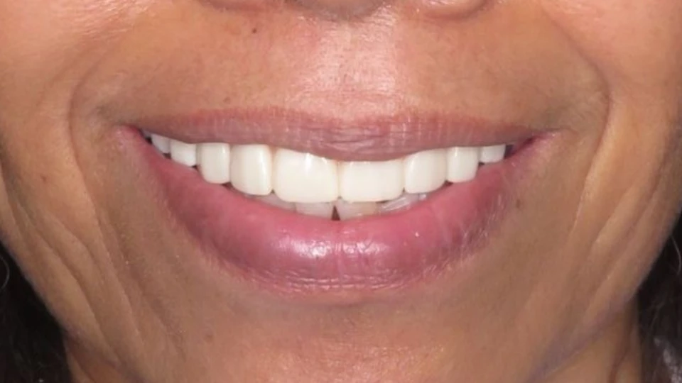 Janice’s new natural-looking All-on-4 smile