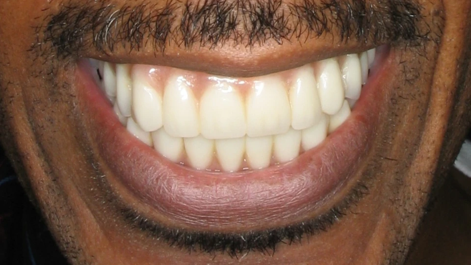 Stephen’s restored smile based on photos of his natural teeth