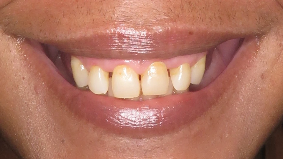 Charlie’s smile with only front teeth and no back teeth