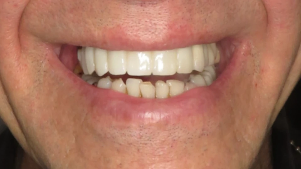 Greg’s partial implant-supported smile with failing back teeth