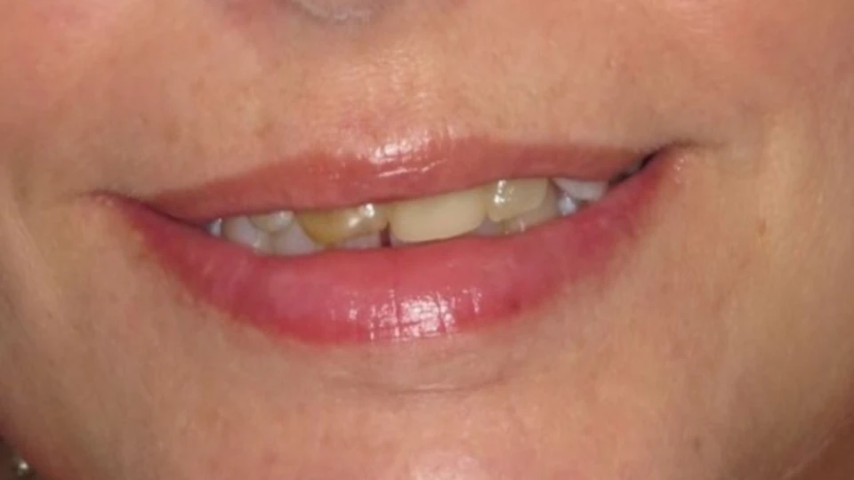 Julia’s discolored and damaged front teeth due to childhood trauma