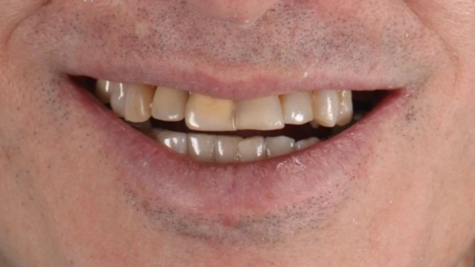 Graham’s failing upper dental work before treatment