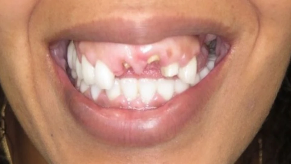 Jenny’s high smile line with deteriorating crowns and uneven gums
