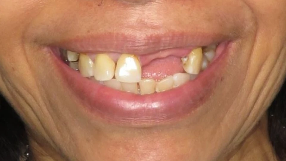 Janice’s partially edentulous smile with bone loss