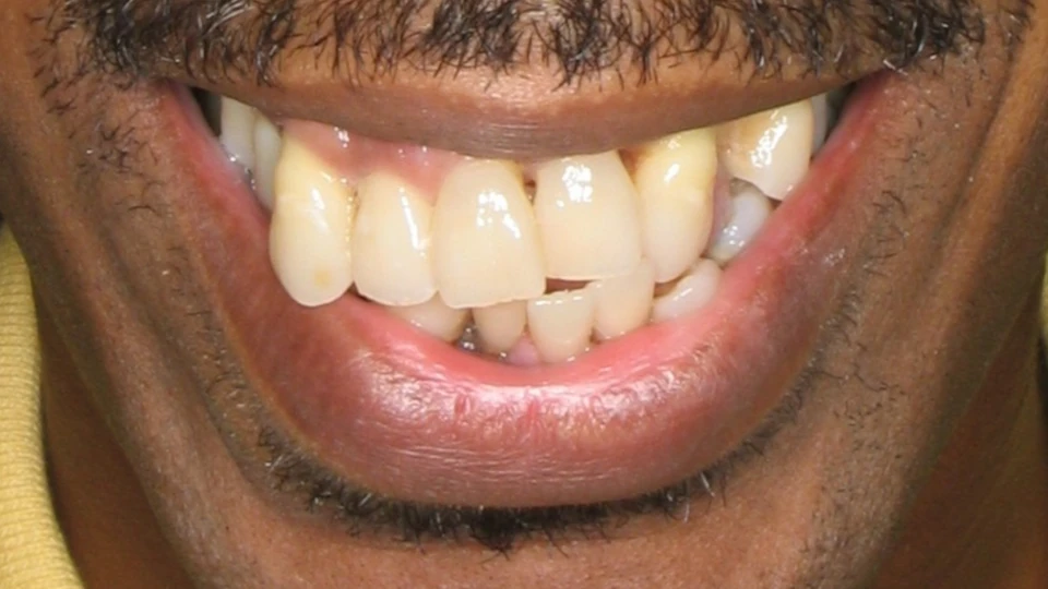 Stephen’s severe periodontal disease and deteriorating smile