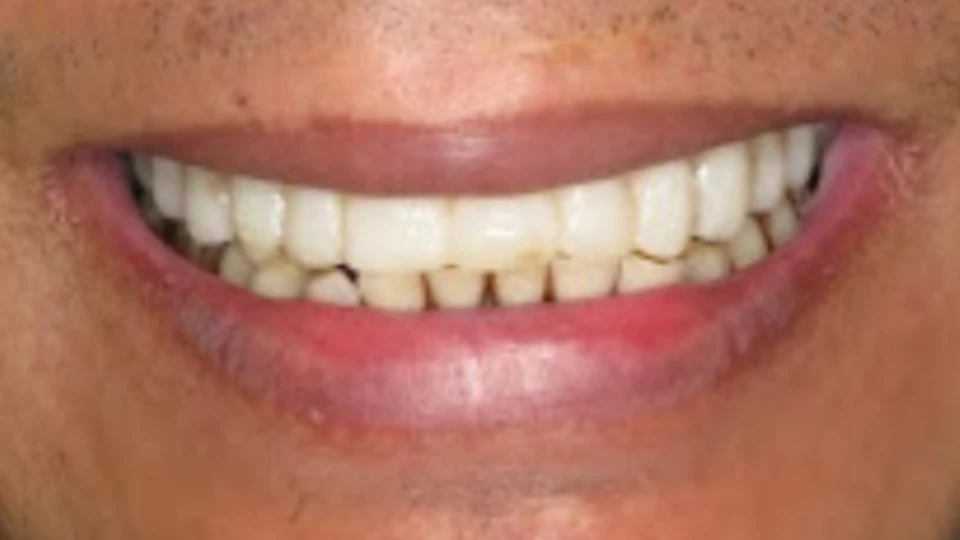 Anurak’s smile restored with All-on-4 and nanoceramic bridge