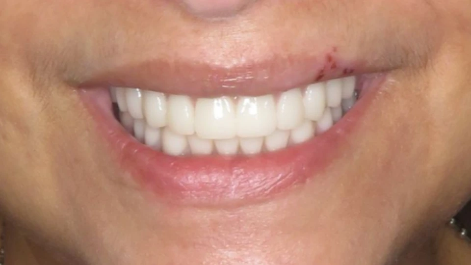 Monica’s balanced, youthful smile post All-on-4 restoration