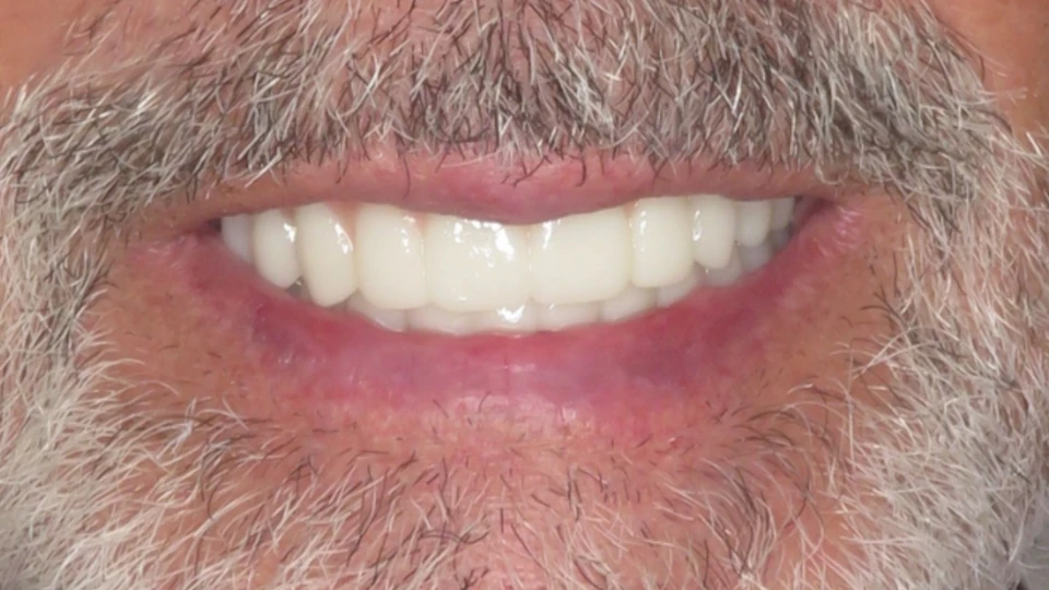 George's smile after full-arch restoration using All-on-4 dental implants