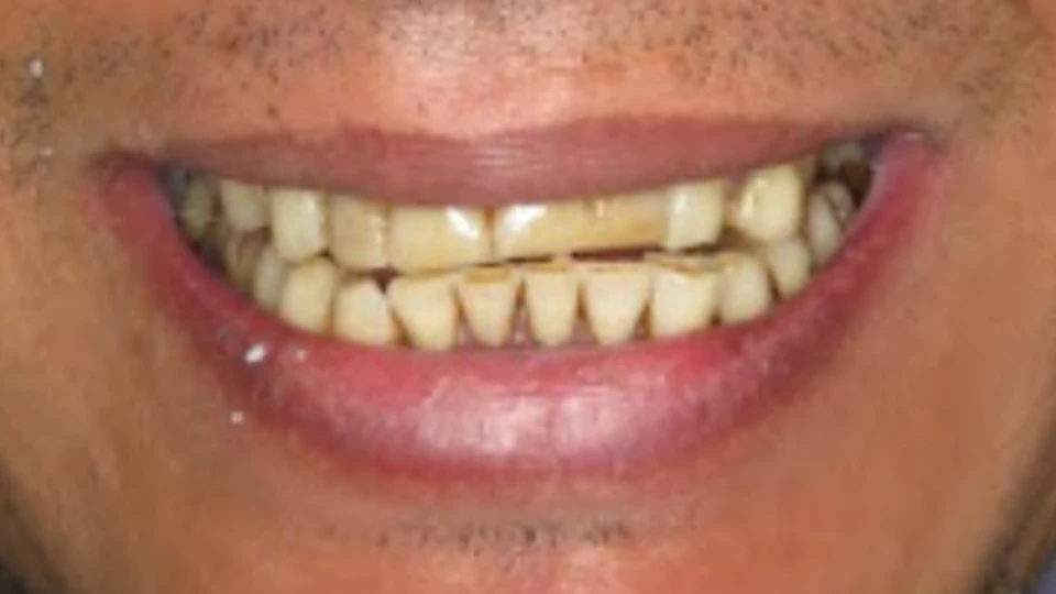 Anurak’s discolored and failing teeth before treatment