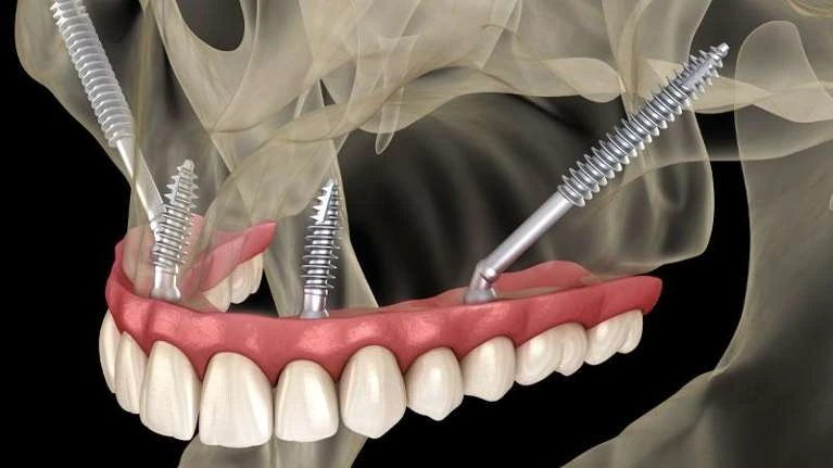 Pterygoid Implants
