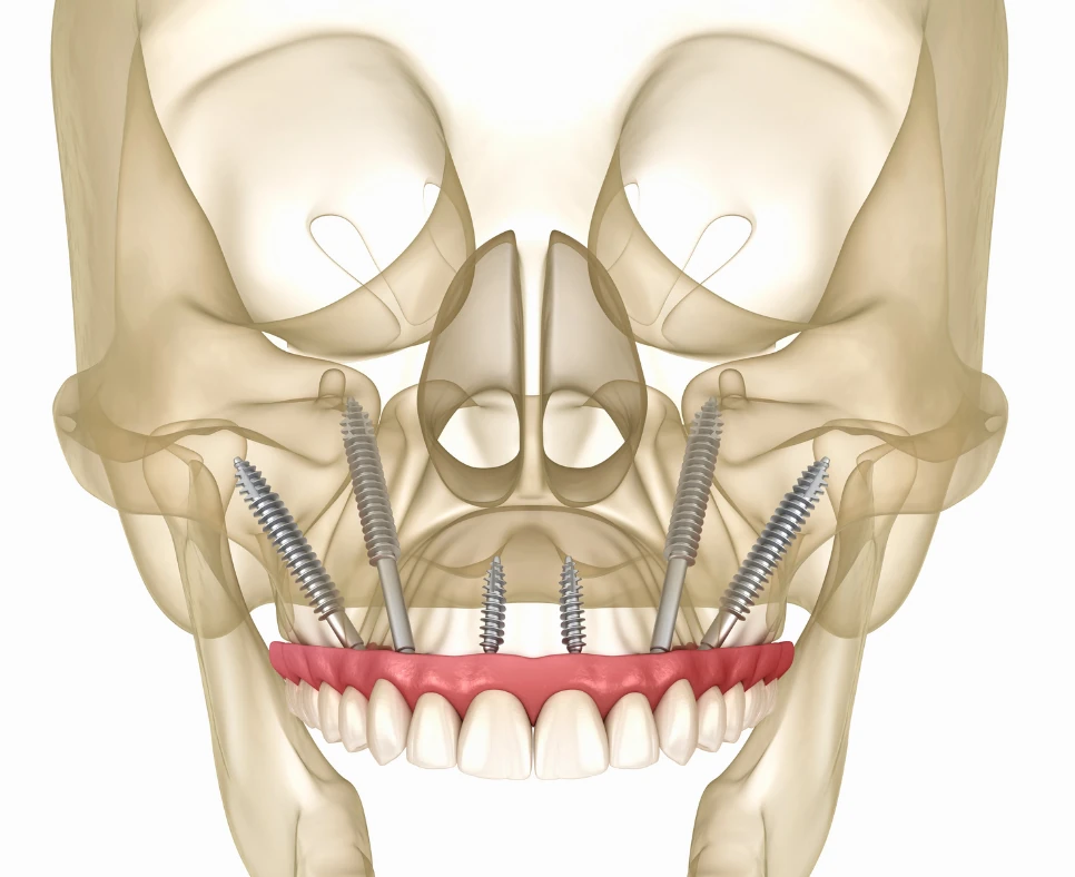 Zygomatic Implants illustration