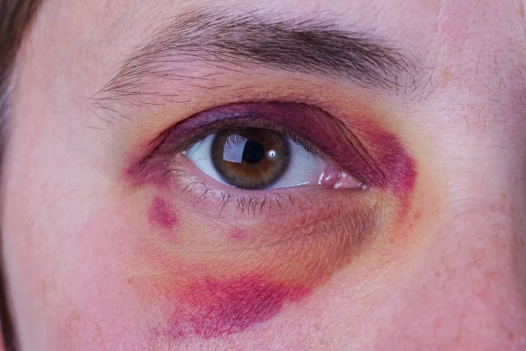 Black eye