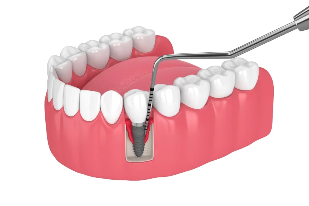 Dental cleaning tool treating peri implantitis